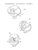 SPINAL NUCLEUS REPLACEMENT IMPLANTS diagram and image