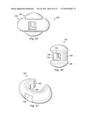 SPINAL NUCLEUS REPLACEMENT IMPLANTS diagram and image