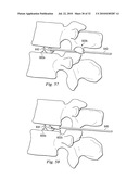 SPINAL NUCLEUS REPLACEMENT IMPLANTS diagram and image