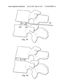 SPINAL NUCLEUS REPLACEMENT IMPLANTS diagram and image