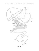 GASTROINTESTINAL IMPLANT AND METHODS FOR USE diagram and image