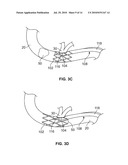 GASTROINTESTINAL IMPLANT AND METHODS FOR USE diagram and image