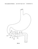 GASTROINTESTINAL IMPLANT AND METHODS FOR USE diagram and image