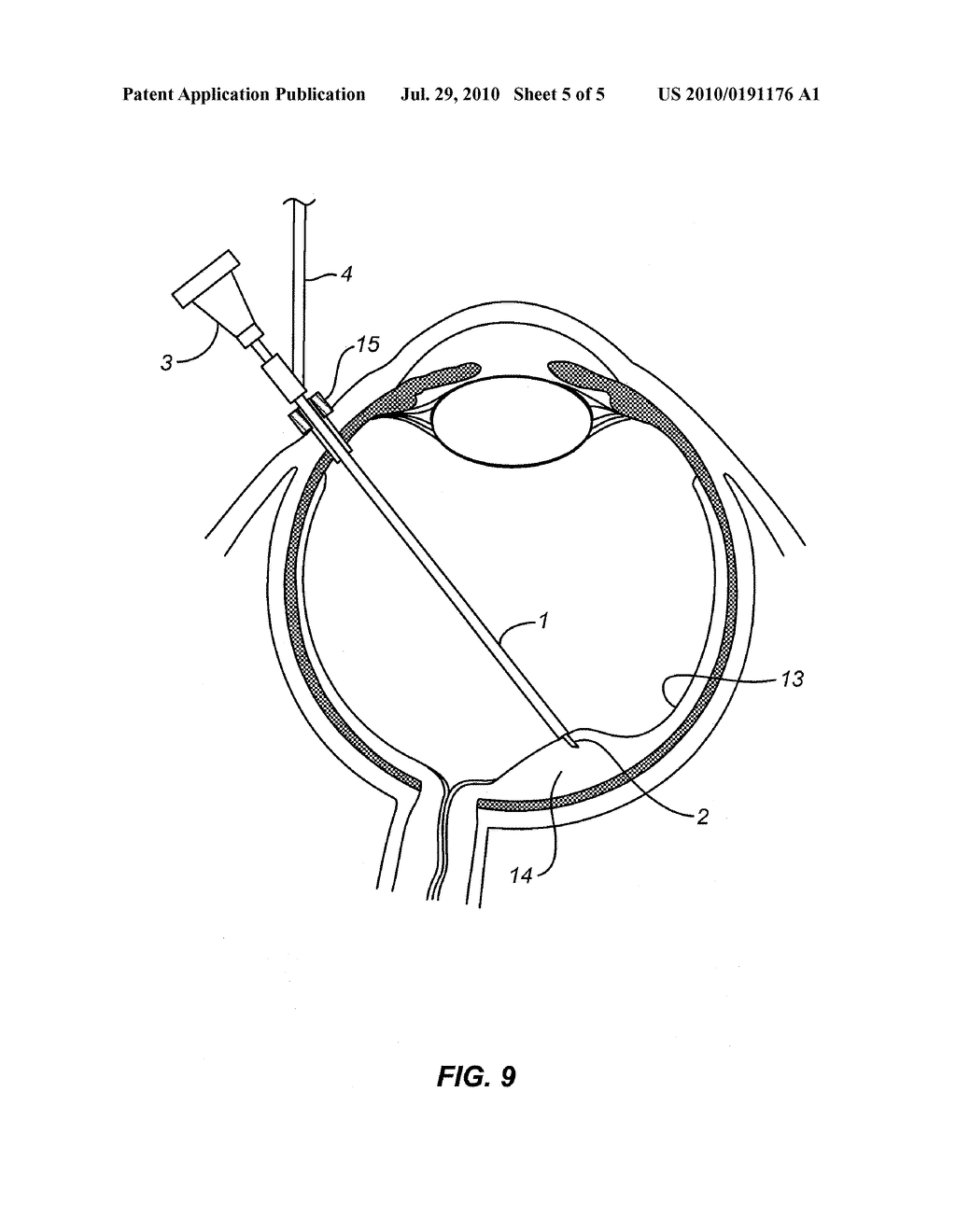 SUBRETINAL ACCESS DEVICE - diagram, schematic, and image 06