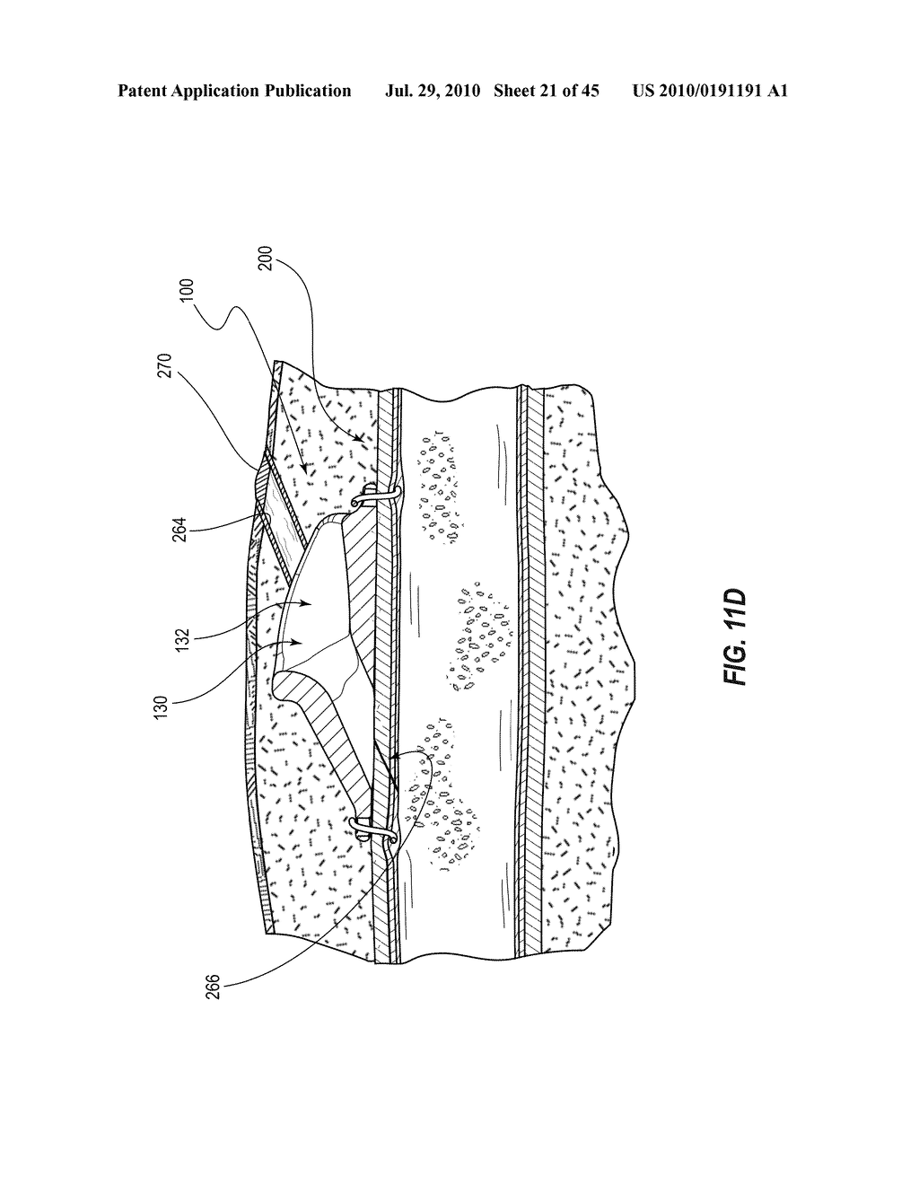 SUBCUTANEOUS VASCULAR ACCESS PORTS AND RELATED SYSTEMS, METHODS, AND IMPLANTATION FEATURES - diagram, schematic, and image 22