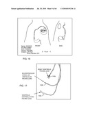 SWITCHED DIVERTER CIRCUITS FOR MINIMIZING HEATING OF AN IMPLANTED LEAD AND/OR PROVIDING EMI PROTECTION IN A HIGH POWER ELECTROMAGNETIC FIELD ENVIRONMENT diagram and image