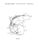 SWITCHED DIVERTER CIRCUITS FOR MINIMIZING HEATING OF AN IMPLANTED LEAD AND/OR PROVIDING EMI PROTECTION IN A HIGH POWER ELECTROMAGNETIC FIELD ENVIRONMENT diagram and image