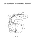 SWITCHED DIVERTER CIRCUITS FOR MINIMIZING HEATING OF AN IMPLANTED LEAD AND/OR PROVIDING EMI PROTECTION IN A HIGH POWER ELECTROMAGNETIC FIELD ENVIRONMENT diagram and image