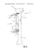 System for Correcting Bones diagram and image