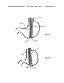 DEVICES, SYSTEMS AND METHODS FOR DIAGNOSING AND DELIVERING THERAPEUTIC INTERVENTIONS IN THE PERITONEAL CAVITY diagram and image