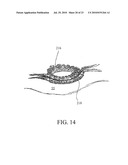 DEVICES, SYSTEMS AND METHODS FOR DIAGNOSING AND DELIVERING THERAPEUTIC INTERVENTIONS IN THE PERITONEAL CAVITY diagram and image