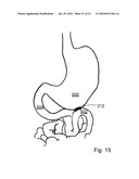 DEVICES, SYSTEMS AND METHODS FOR DIAGNOSING AND DELIVERING THERAPEUTIC INTERVENTIONS IN THE PERITONEAL CAVITY diagram and image