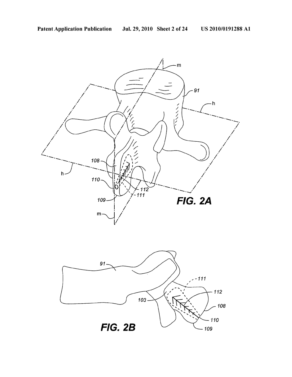 ADJUSTABLE SPINAL IMPLANT DEVICE AND METHOD - diagram, schematic, and image 03