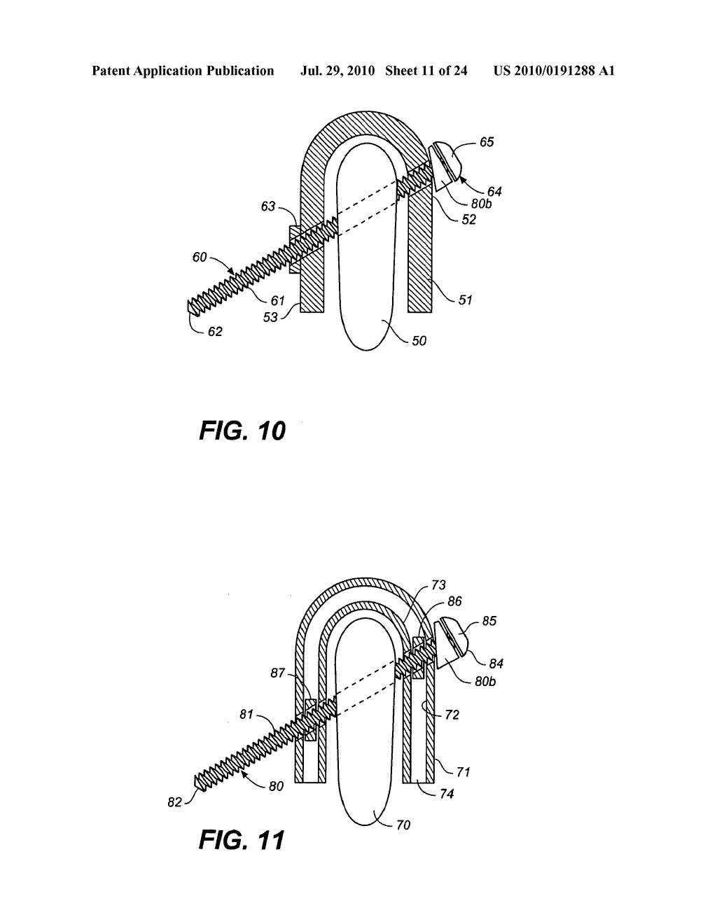 ADJUSTABLE SPINAL IMPLANT DEVICE AND METHOD - diagram, schematic, and image 12