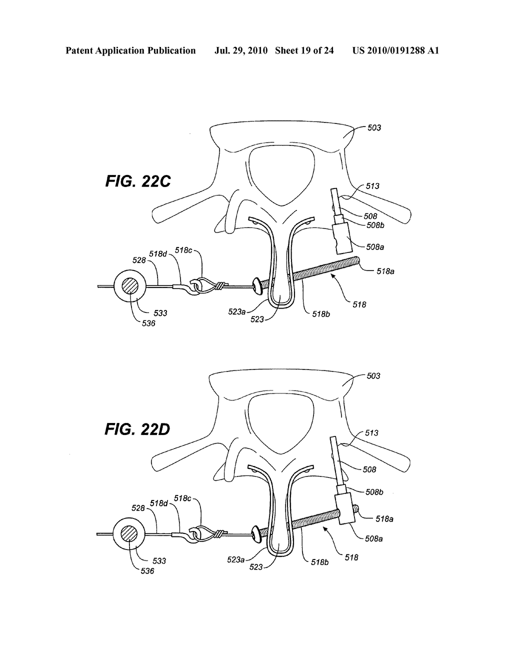 ADJUSTABLE SPINAL IMPLANT DEVICE AND METHOD - diagram, schematic, and image 20