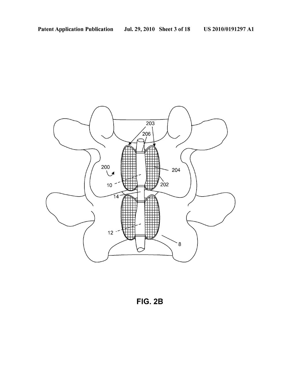 SYSTEMS AND METHODS FOR INJECTING BONE FILLER INTO THE SPINE - diagram, schematic, and image 04