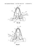 SYSTEMS AND METHODS FOR INJECTING BONE FILLER INTO THE SPINE diagram and image