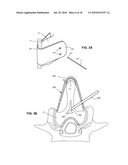 SYSTEMS AND METHODS FOR INJECTING BONE FILLER INTO THE SPINE diagram and image