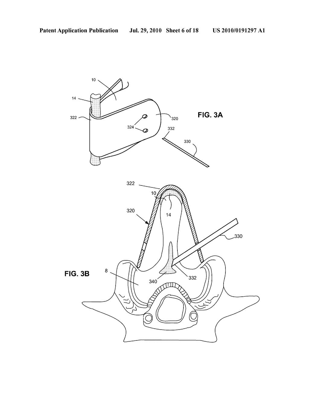 SYSTEMS AND METHODS FOR INJECTING BONE FILLER INTO THE SPINE - diagram, schematic, and image 07