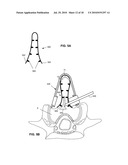 SYSTEMS AND METHODS FOR INJECTING BONE FILLER INTO THE SPINE diagram and image