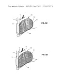 SYSTEMS AND METHODS FOR INJECTING BONE FILLER INTO THE SPINE diagram and image