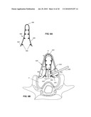 SYSTEMS AND METHODS FOR INJECTING BONE FILLER INTO THE SPINE diagram and image