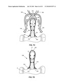 SYSTEMS AND METHODS FOR INJECTING BONE FILLER INTO THE SPINE diagram and image