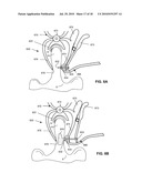 SYSTEMS AND METHODS FOR INJECTING BONE FILLER INTO THE SPINE diagram and image