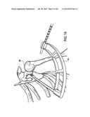 Articulating humeral Head Prosthesis diagram and image