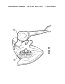 Articulating humeral Head Prosthesis diagram and image