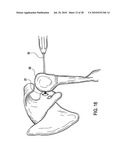 Articulating humeral Head Prosthesis diagram and image