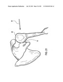 Articulating humeral Head Prosthesis diagram and image