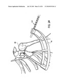 Articulating humeral Head Prosthesis diagram and image