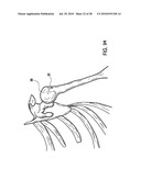 Articulating humeral Head Prosthesis diagram and image