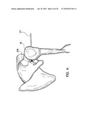 Articulating humeral Head Prosthesis diagram and image