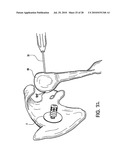 Articulating humeral Head Prosthesis diagram and image