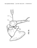 Articulating humeral Head Prosthesis diagram and image