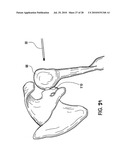 Articulating humeral Head Prosthesis diagram and image