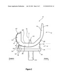 LATERAL CONDYLE POSTERIOR INFLECTION FOR TOTAL KNEE IMPLANT diagram and image