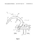 LATERAL CONDYLE POSTERIOR INFLECTION FOR TOTAL KNEE IMPLANT diagram and image