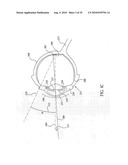 ORTHOVOLTAGE RADIOTHERAPY diagram and image