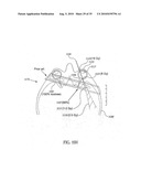 ORTHOVOLTAGE RADIOTHERAPY diagram and image