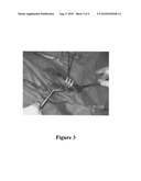 Compositions and methods for treatment of tumors by direct administration of a radioisotope diagram and image