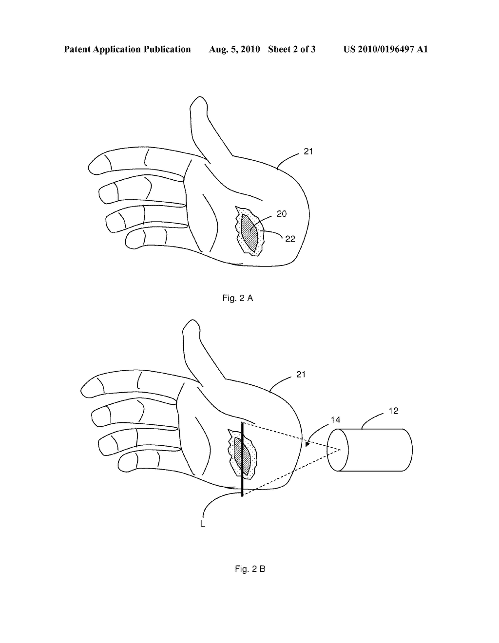 Method of Treating Tissue Using Platelet-Rich Plasma in Combination with Low-Level Laser Therapy - diagram, schematic, and image 03