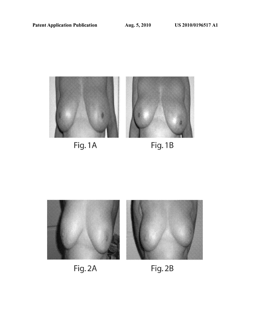 TOPICAL DELIVERY OF A NITRIC OXIDE DONOR TO IMPROVE BODY AND SKIN APPEARANCE - diagram, schematic, and image 02