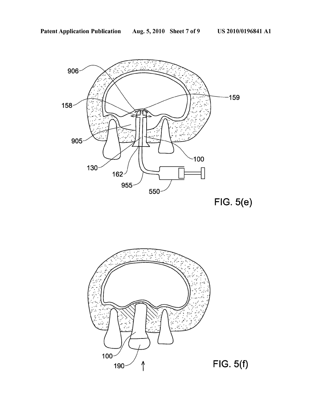 Dental implants, devices and methods associated with dental implantation procedures - diagram, schematic, and image 08