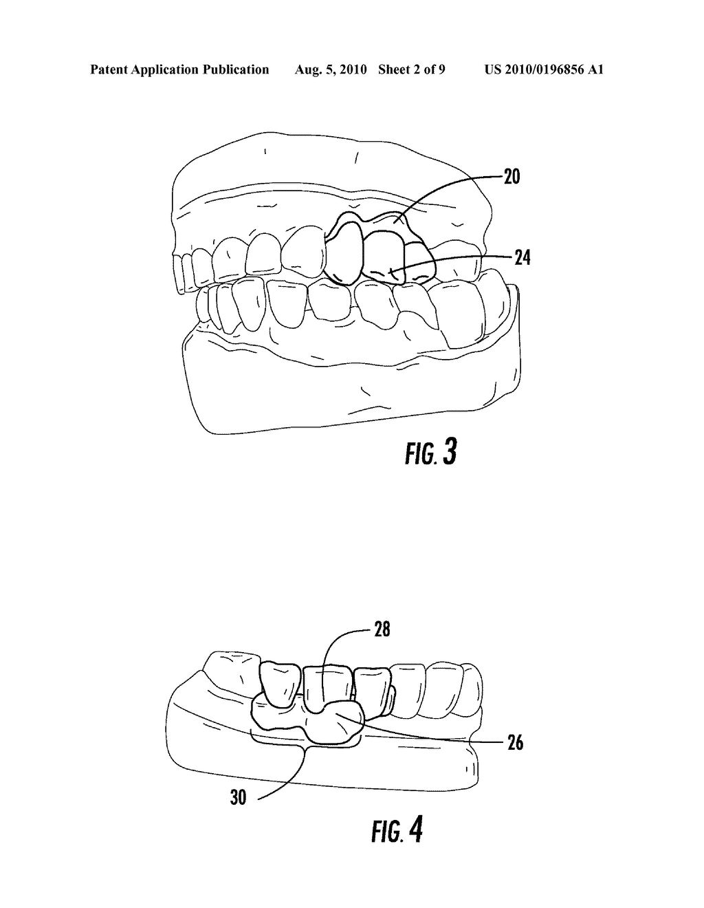 METHOD OF MAKING AN ORAL PROSTHESIS - diagram, schematic, and image 03