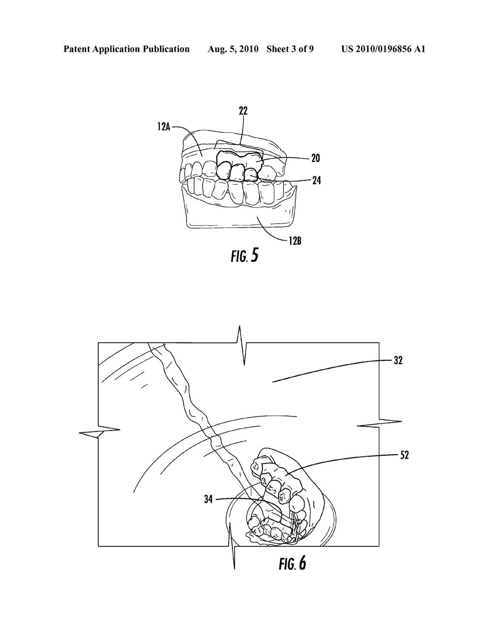 METHOD OF MAKING AN ORAL PROSTHESIS - diagram, schematic, and image 04