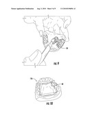 METHOD OF MAKING AN ORAL PROSTHESIS diagram and image