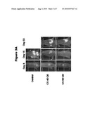 PANCREATIC CANCER TREATMENT diagram and image